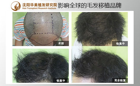 华美植发植发案例效果图