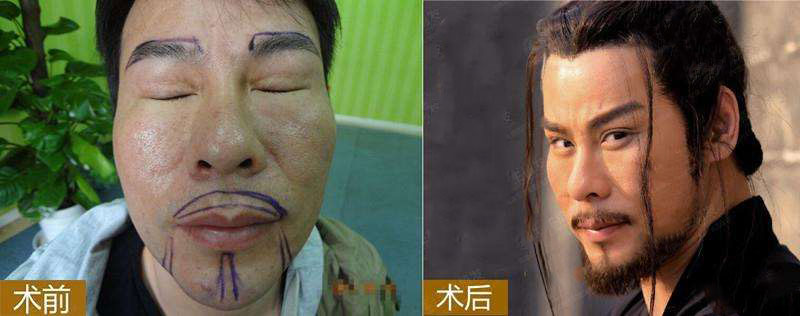 华美植发真正胡须种植案例效果图