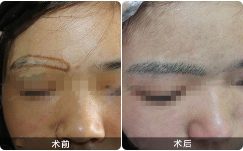华美植发眉毛种植案例效果图