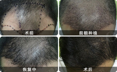 华美植发植发案例效果图