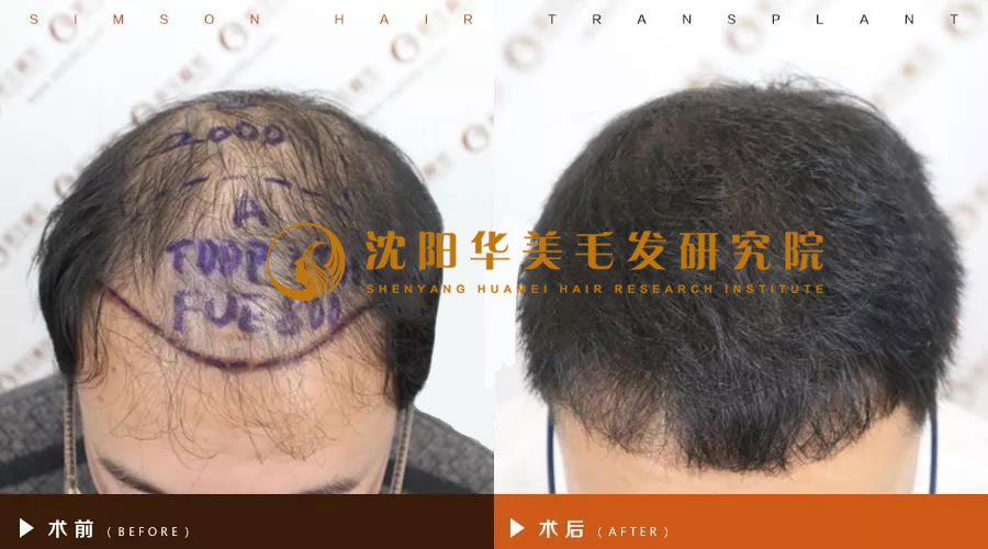 华美植发真正植发案例效果图