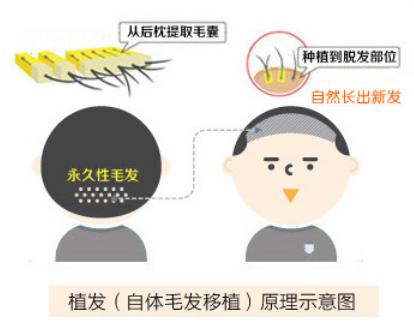 植发.jpg