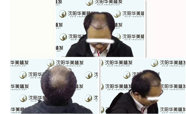 植发前.jpg