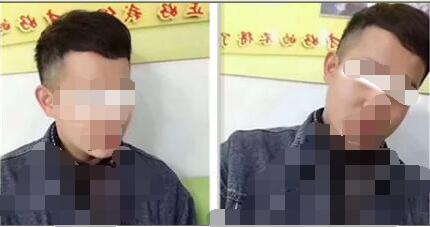 华美植发后.jpg
