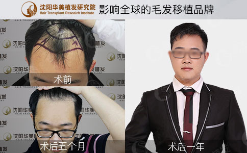 华美植发真正头发种植案例效果图