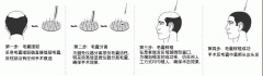 FUE没疤痕植发技术