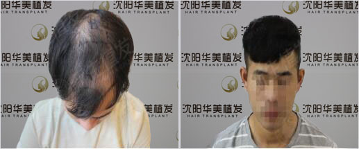 华美植发查先生植发前后对比图