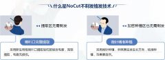 华美医院WZ动态美学植发技术