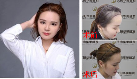 华美植发微针植发技术植发案例效果图